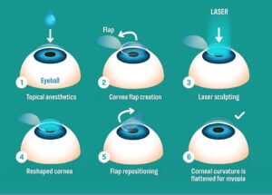 Six-step LASIK procedure diagram showing corneal flap creation, laser reshaping of the cornea, flap repositioning, and flattening of corneal curvature to treat myopia.