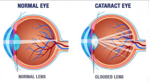 Learn the early signs of cataracts with this cataract digram at wellish abrams vision insittute