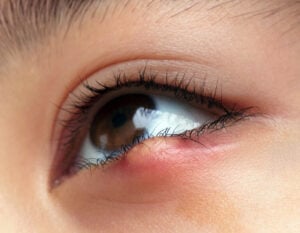 Close-up of a red lump on the eyelid lash line illustrating common eyelid pain causes