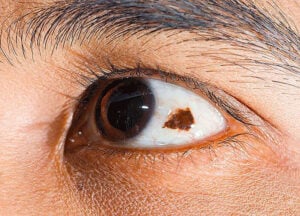bump on eye — close-up of a conjunctival nevus, a flat to slightly raised brown lesion on the white of the eye