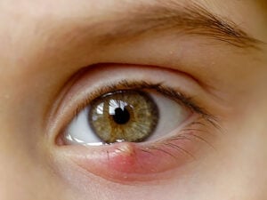 bump on eye — close-up of a lower-eyelid stye causing redness and swelling beneath the eye