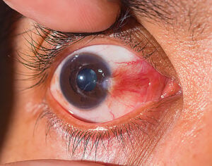 bump on eye — close-up of a pterygium, a fleshy triangular growth extending from the white of the eye toward the cornea