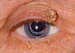 bump on eye — close-up of a seborrheic keratosis on the upper eyelid with waxy, stuck-on surface texture