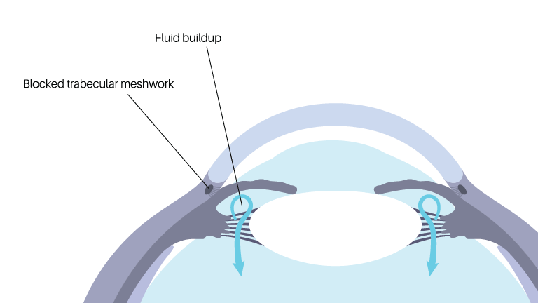 Fluid and pressure build-up that can occur with glaucoma.