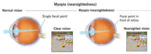Myopia Treatment diagram from Wellish Abrams Vision Institute in Las Vegas, Nevada.