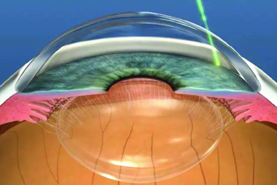 Imagery of selective laser trabeculoplasty