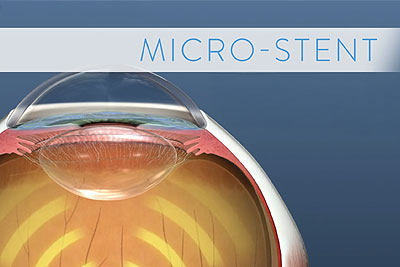 Imagery showing where a minimally invasive glaucoma stent would be implanted.
