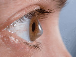 Close-up 3/4 view of an eye showing a cone-shaped corneal bulge, illustrating how a medical eye exam vs routine eye exam may evaluate keratoconus at Wellish Abrams Vision Institute.