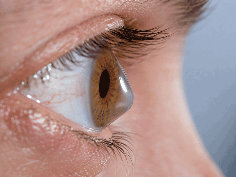 Close-up 3/4 view of an eye showing a cone-shaped corneal bulge, illustrating how a medical eye exam vs routine eye exam may evaluate keratoconus at Wellish Abrams Vision Institute.