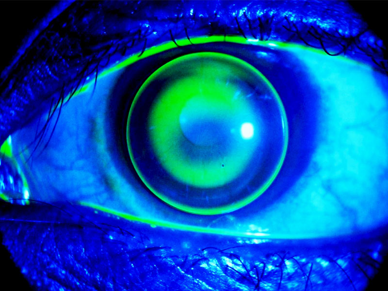 Treatment imagery of corneal cross-linking process.